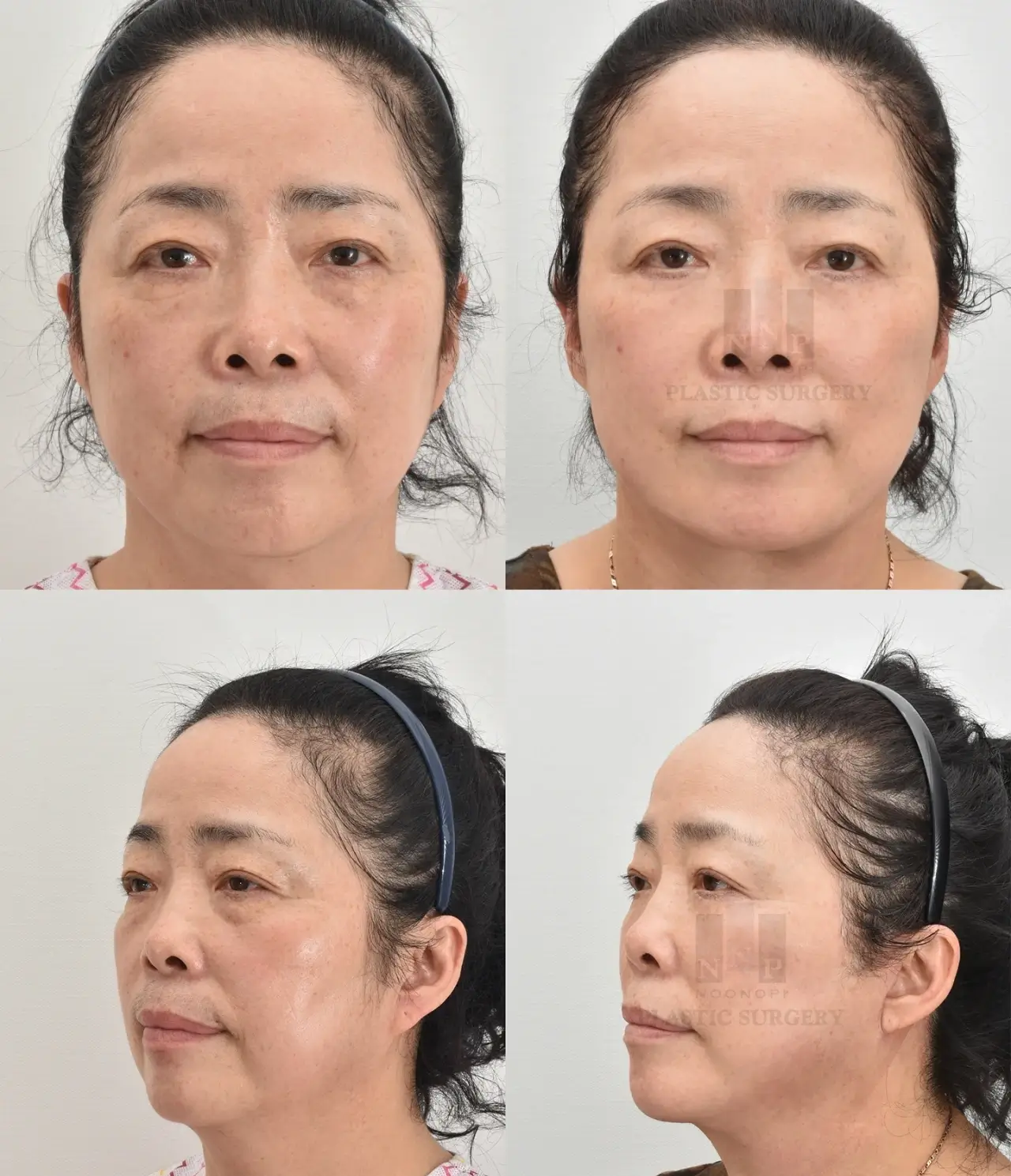 surgical rejuvenation of the face