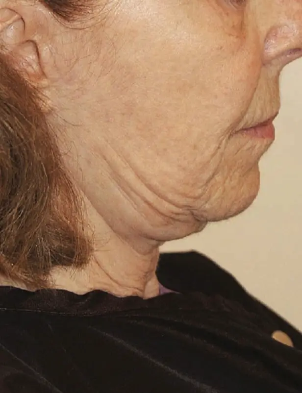facelift complications