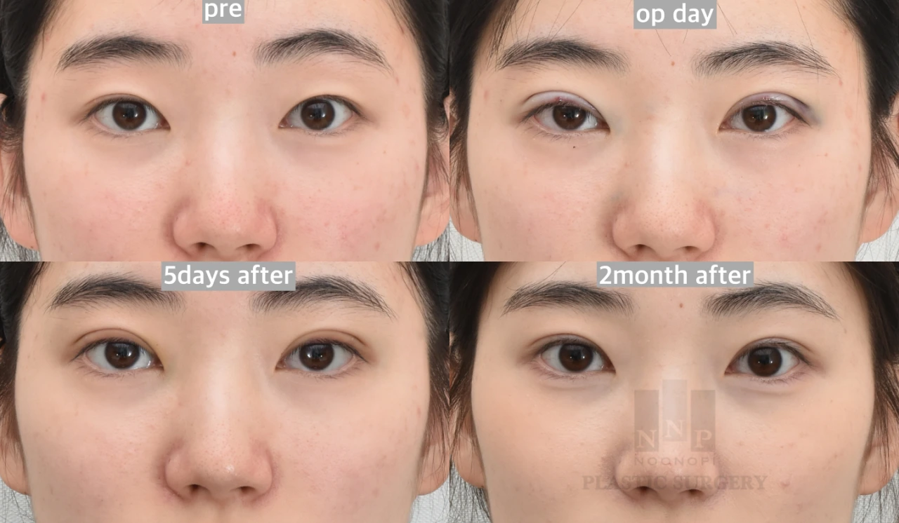 non incisional double eyelid before after