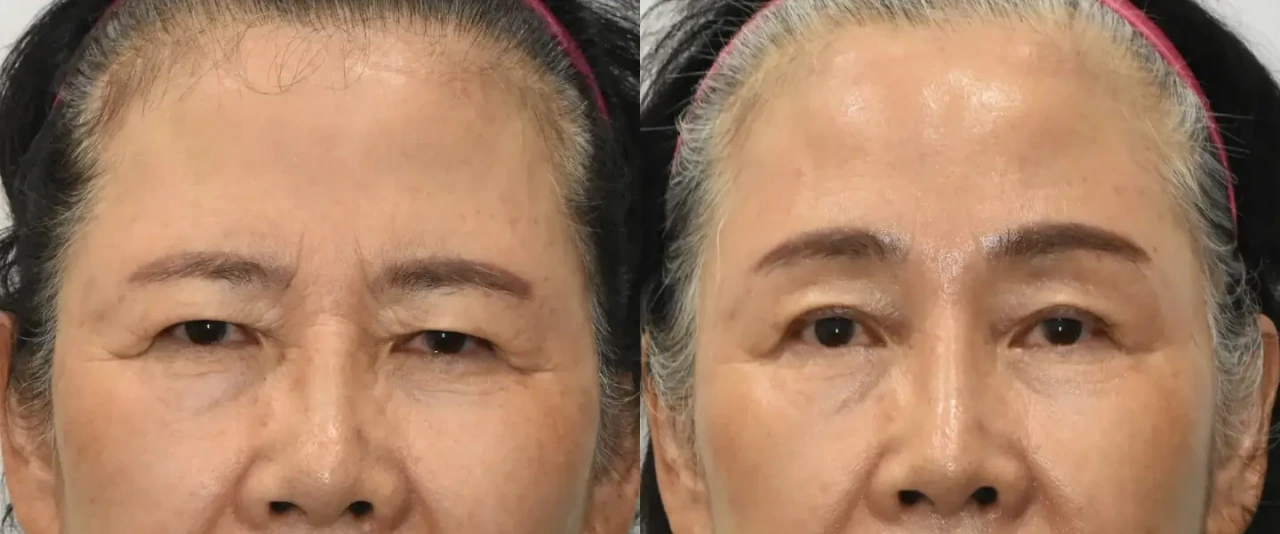 Before and after endoscopic forehead lift results in Korea