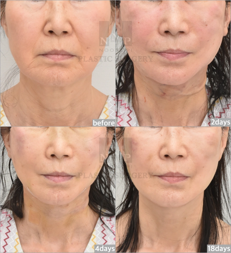 안면거상 전후사진