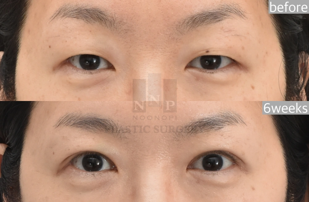 sleepy eyelid surgery