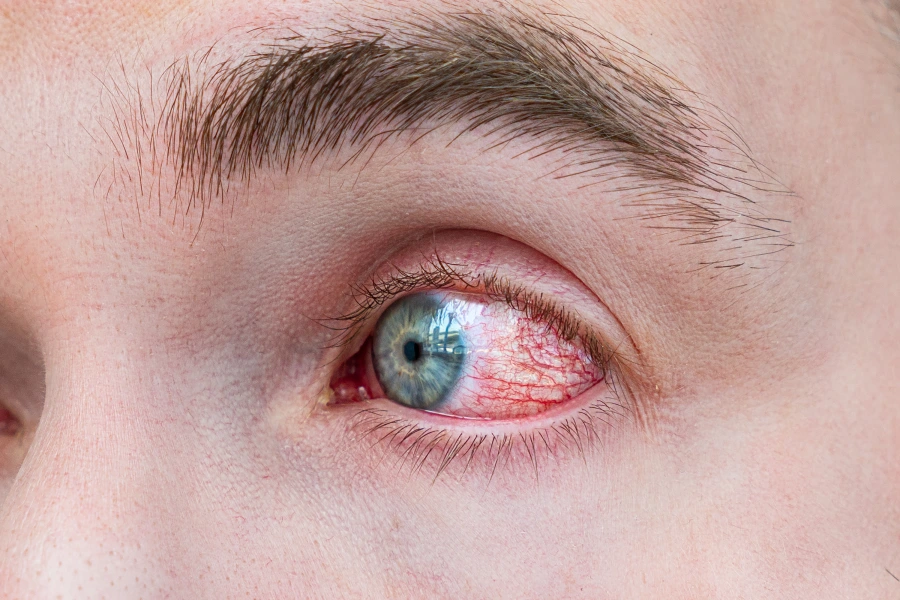 red eye after plastic surgery