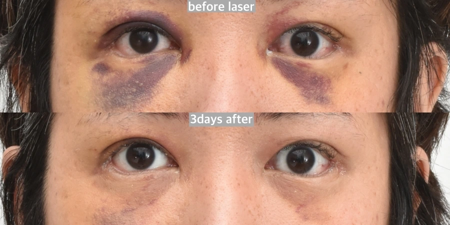 bruise treatment