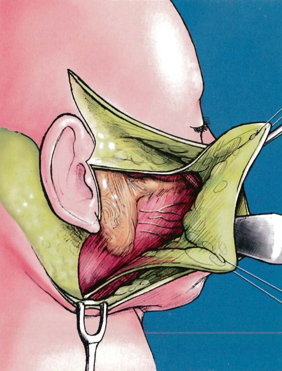 High SMAS facelift