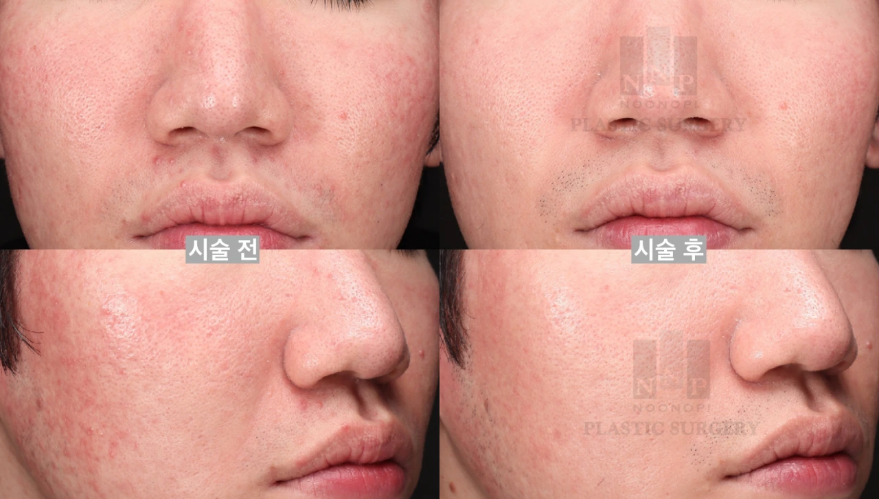 Before & after 2 sessions of acne BBL