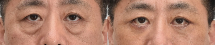 low eyelid Korea before after