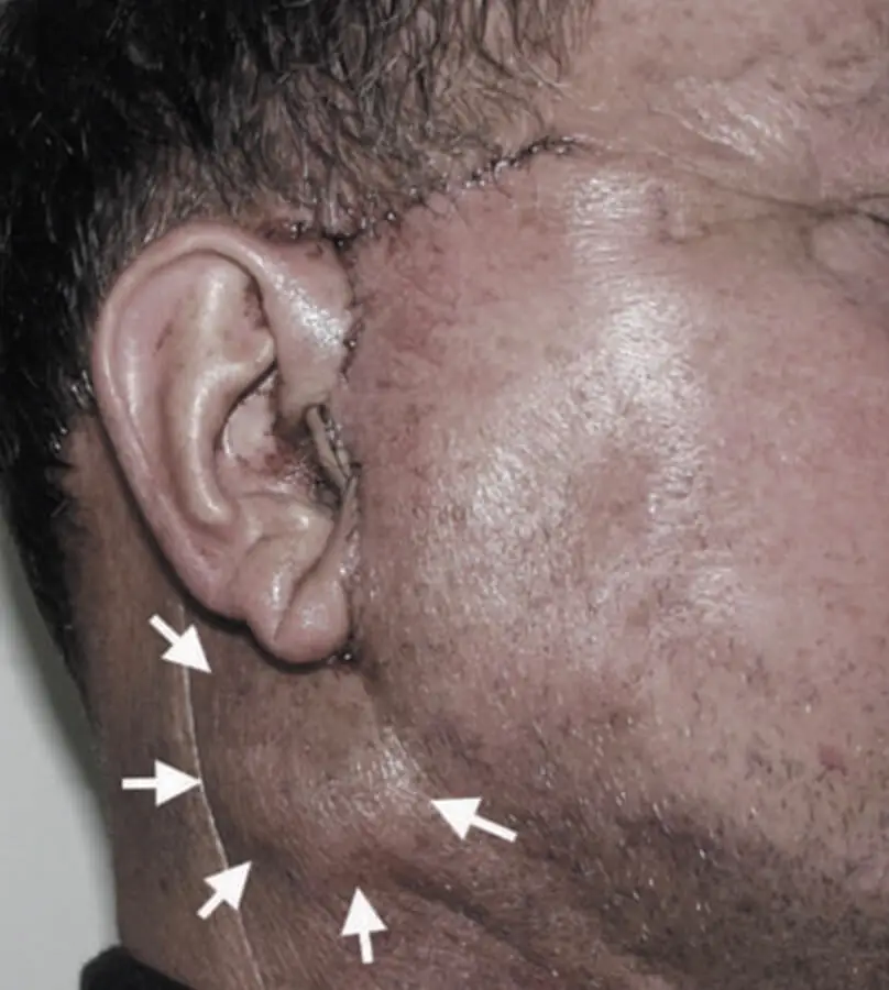 Facelift side effect hematoma