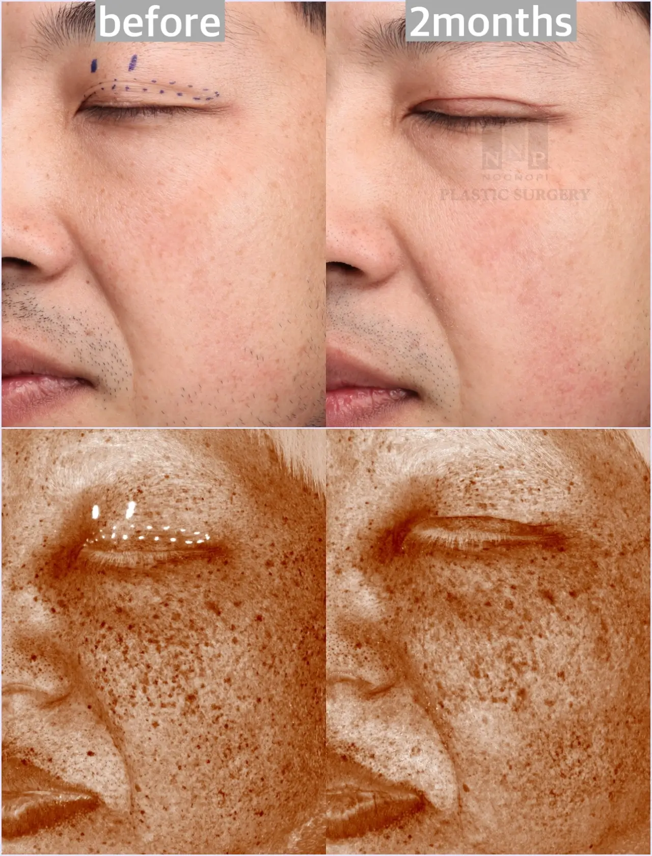 BBL laser before after one session