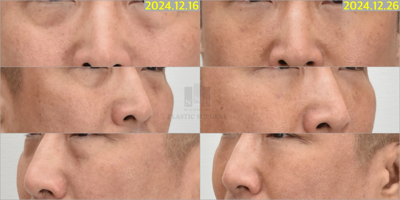 eyebags surgery Korea