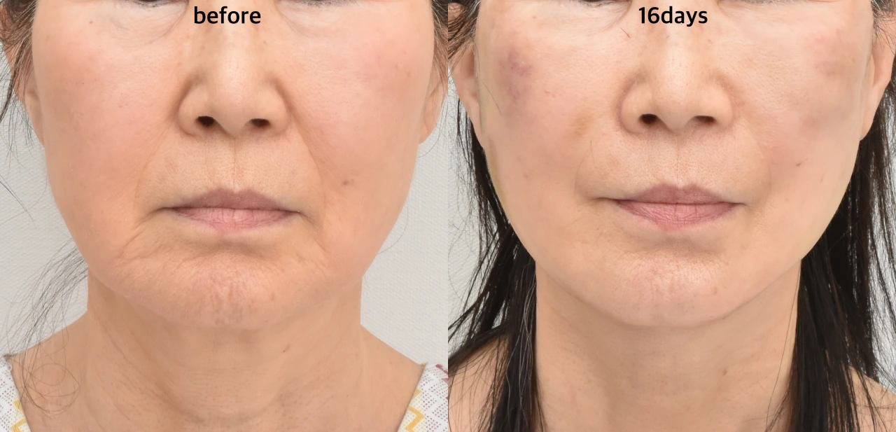 facelift surgery korea before after