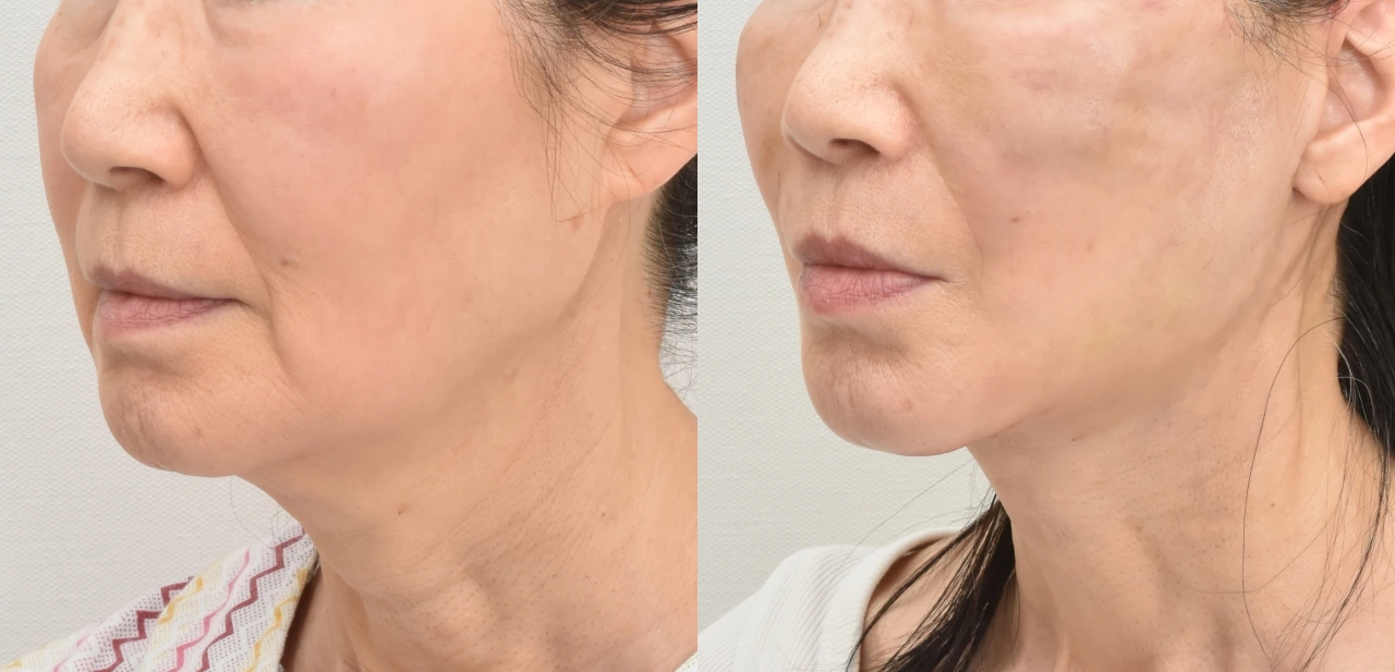 Facelift surgery recovery timeline