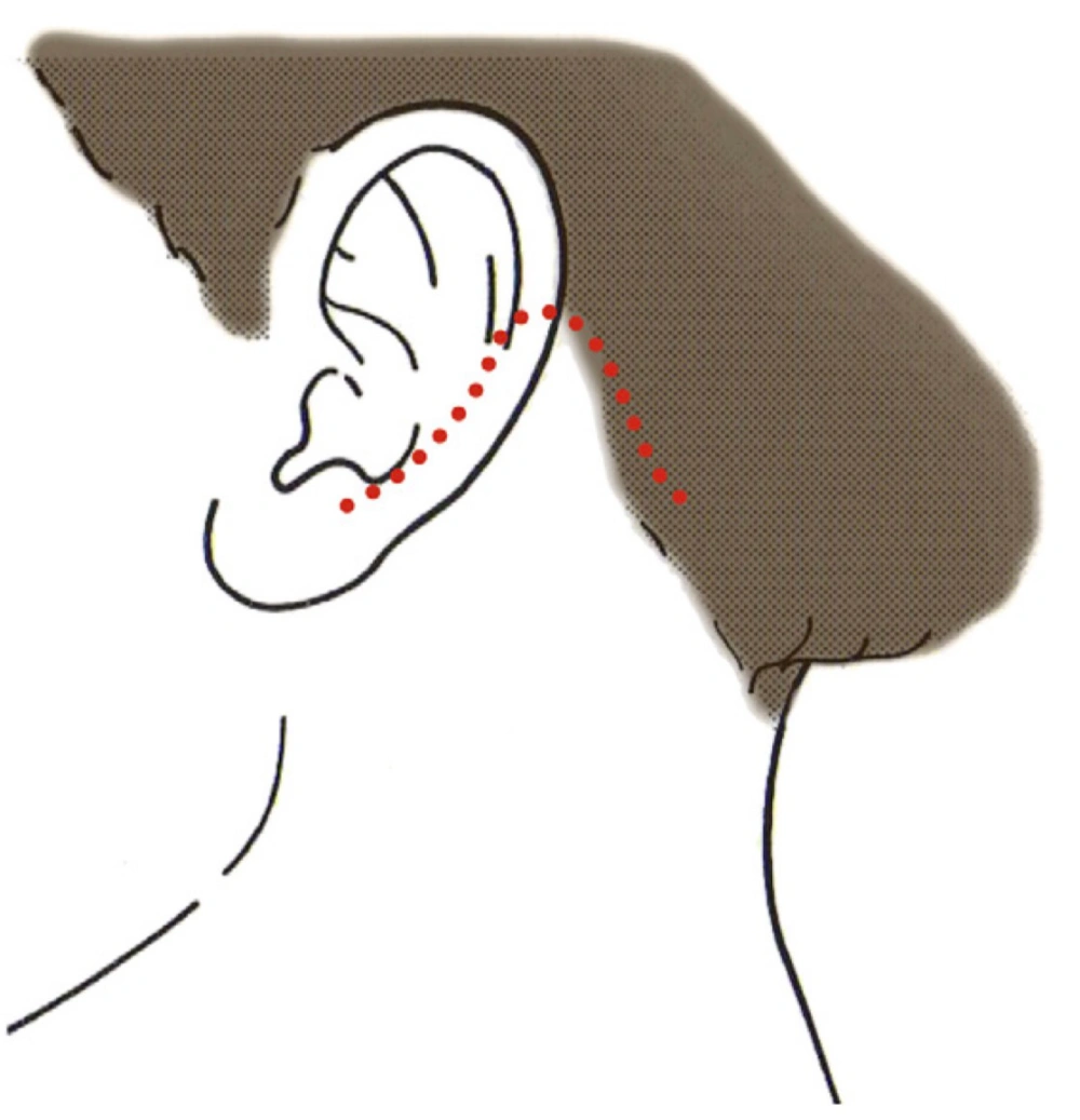 Along the hairline incision