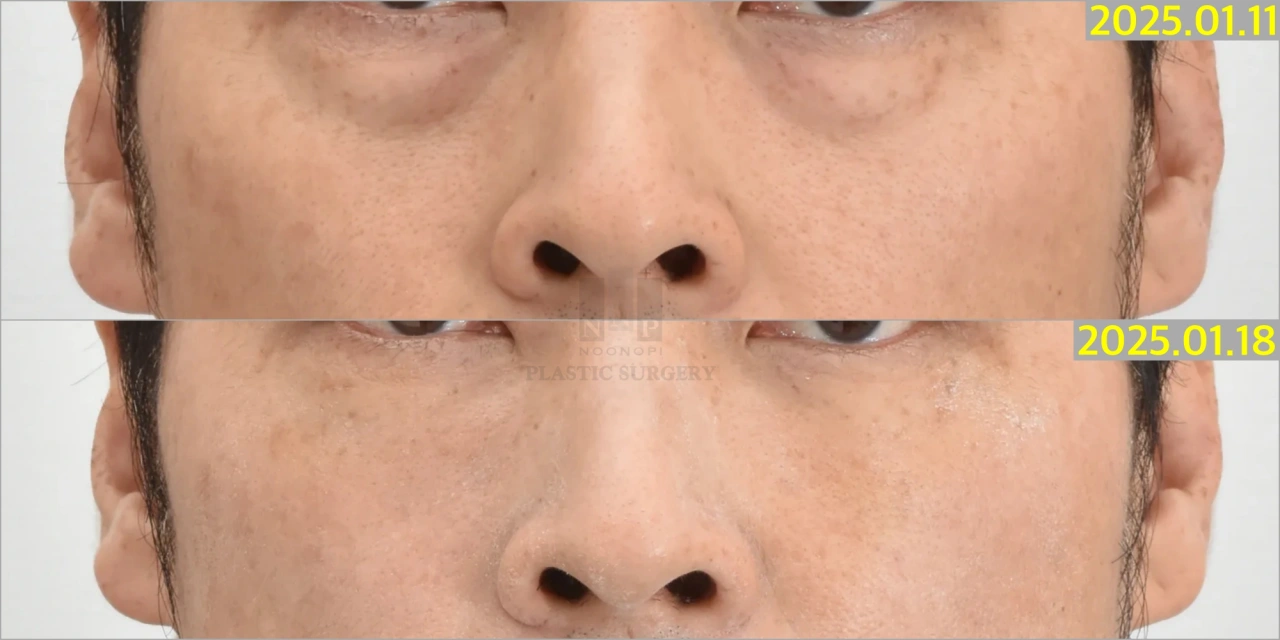Eyebags Surgery in Korea
