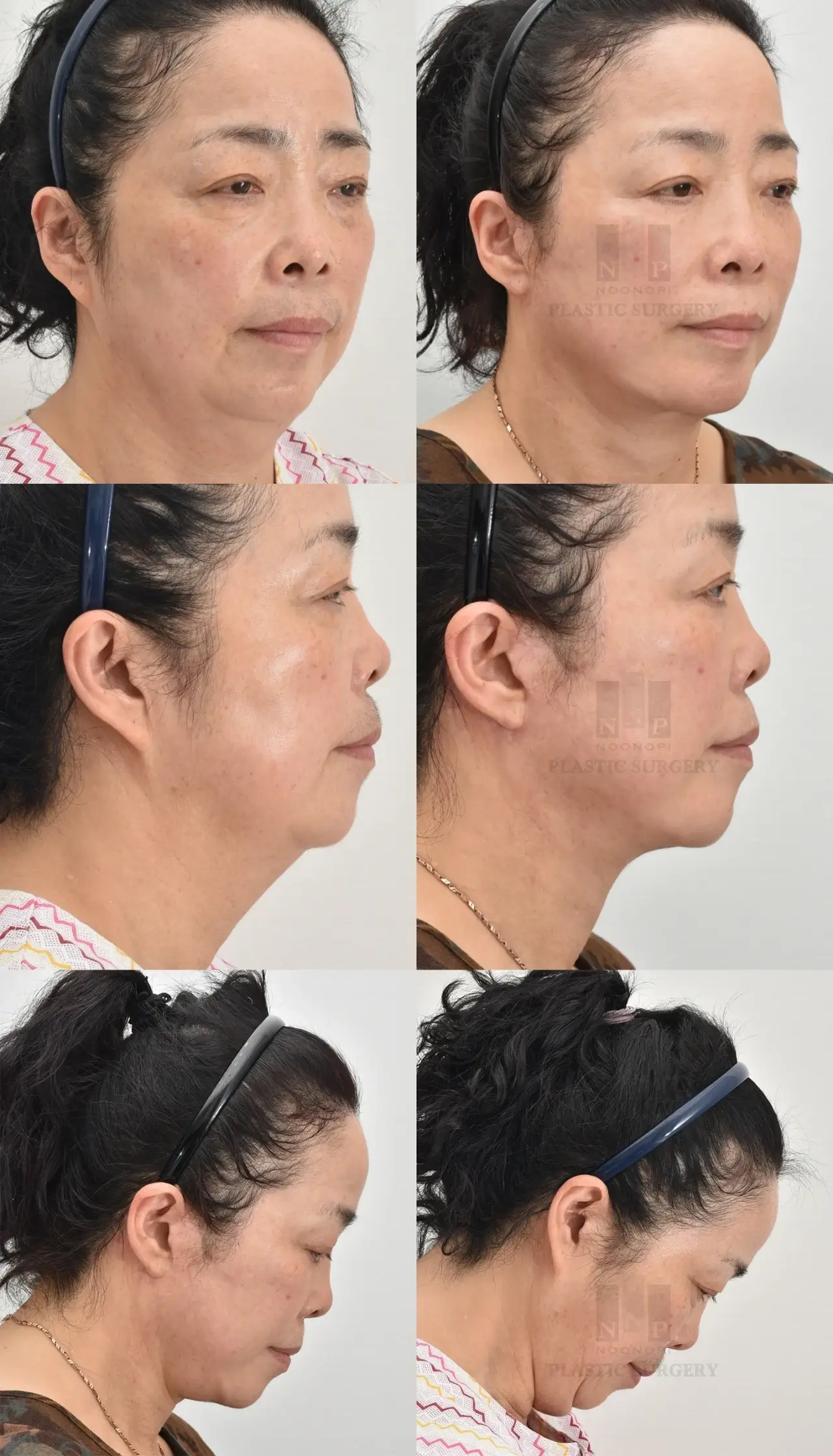 neck lift combination with face