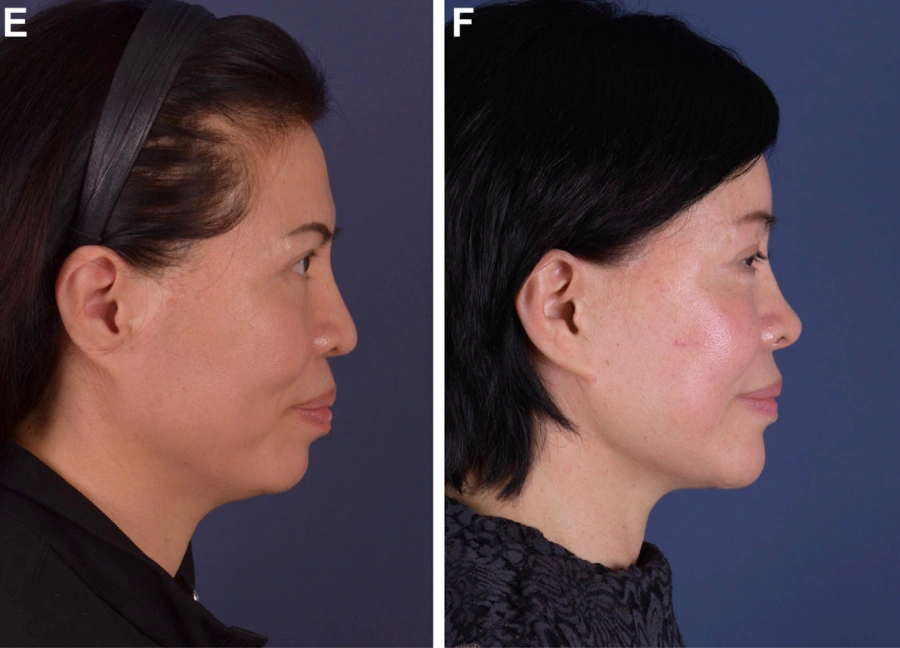 Taek Keun Kwon facelift before after