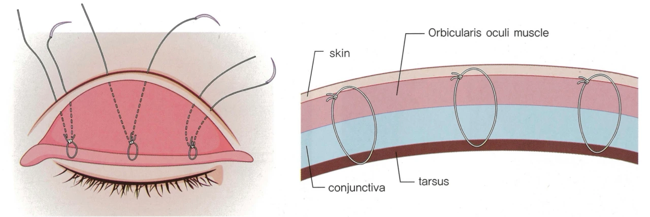 how non-incisional double eyelid works