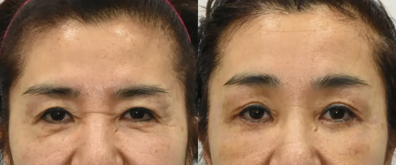Before and after endoscopic brow lift results in Korea