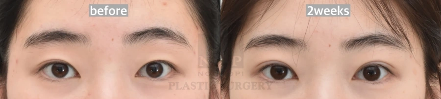 nonincision double eyelid recovery