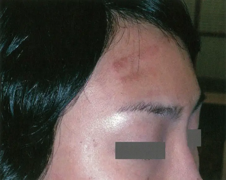 IPL side effect