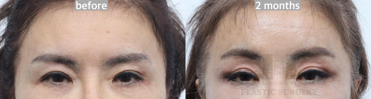 forehead lift results