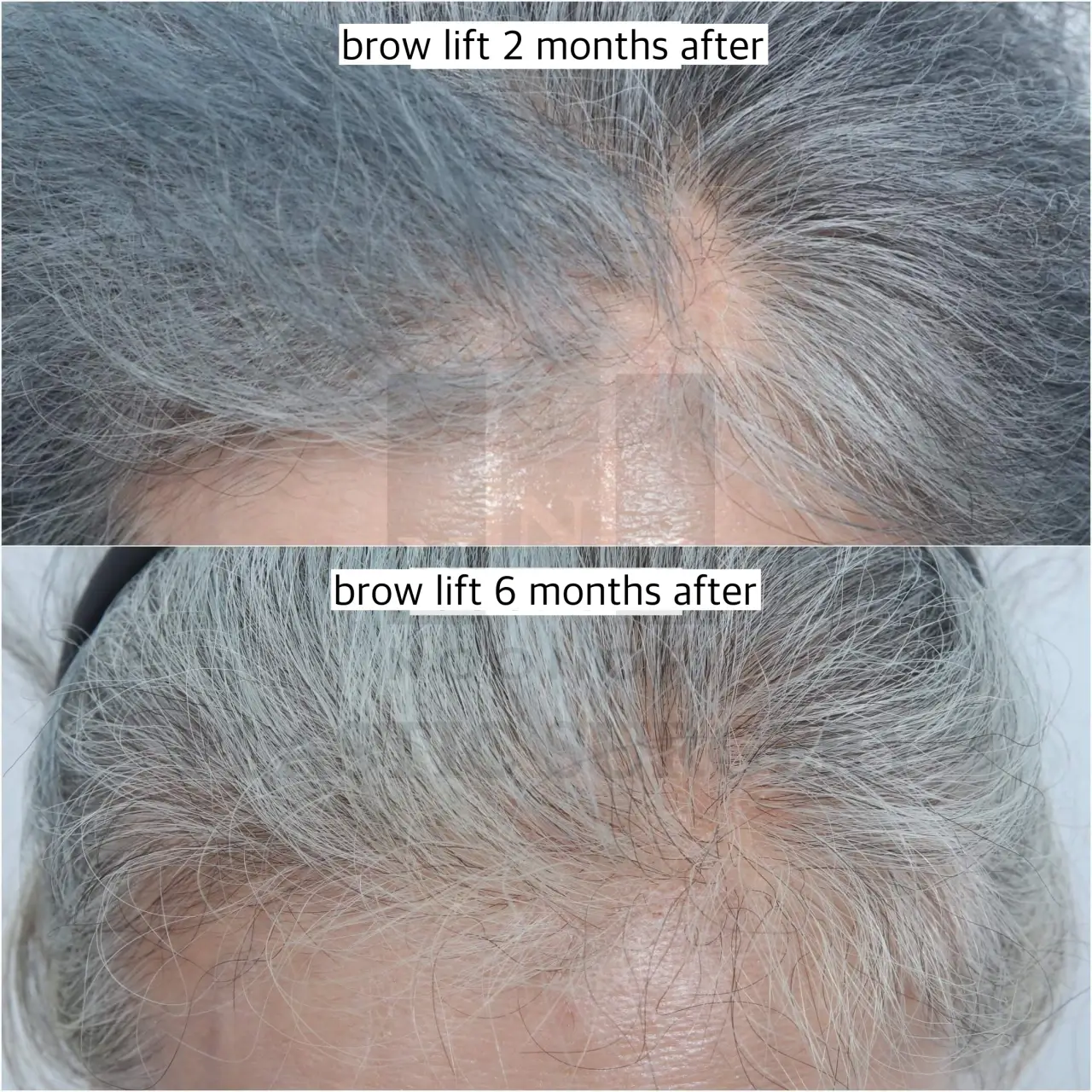 side effect of brow lift temporary hair loss