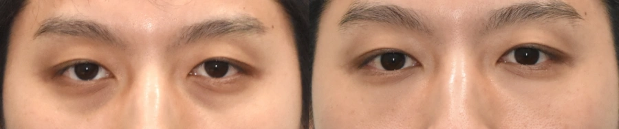 dark circle treatment korea