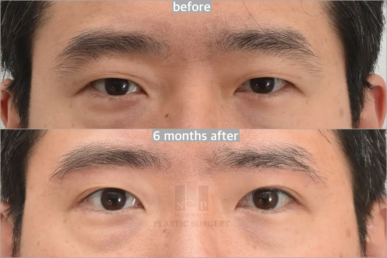 Subbrow lift 6months after
