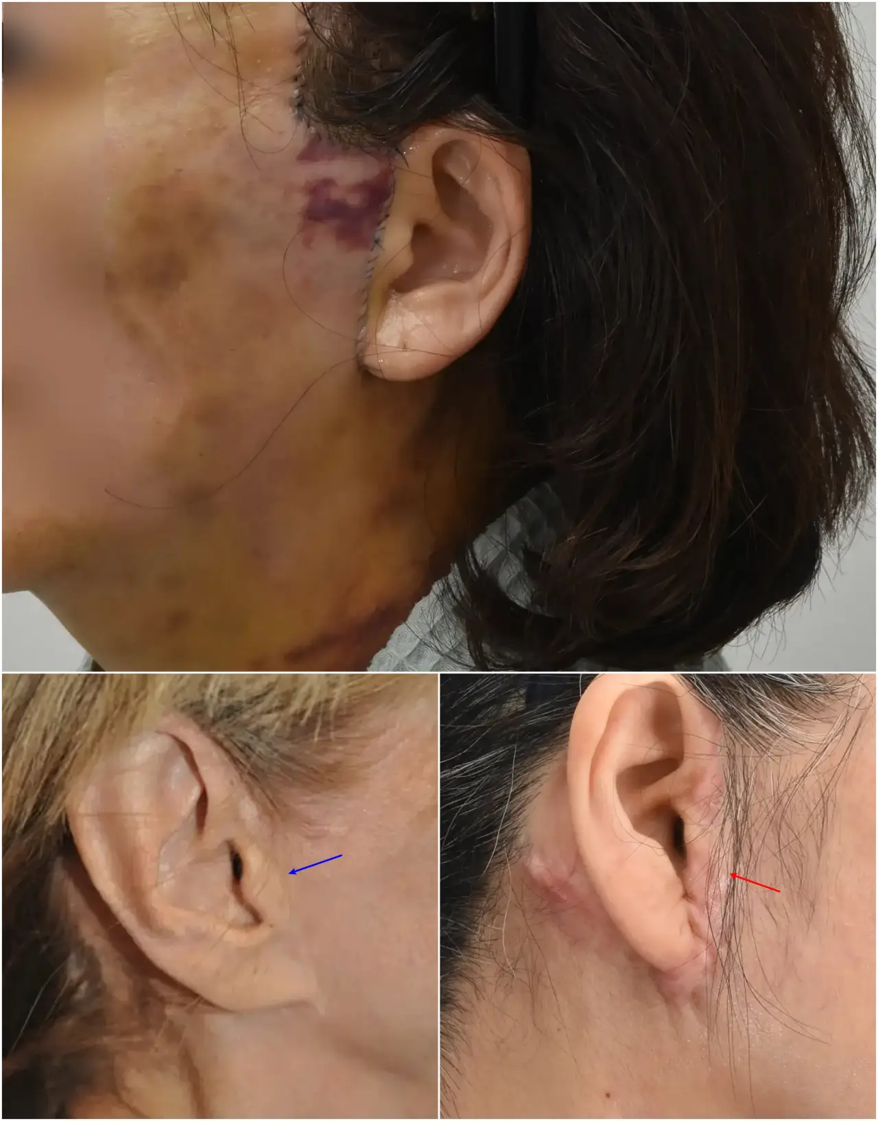 visible tragus scar post-facelift