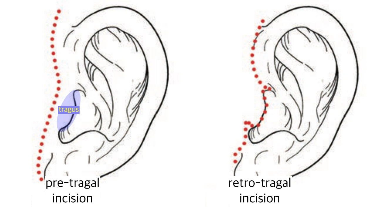 Two types of incision around the ear tragus