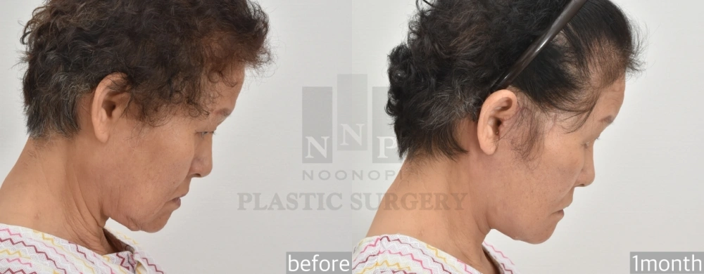 how to get rid of nasolabial folds
