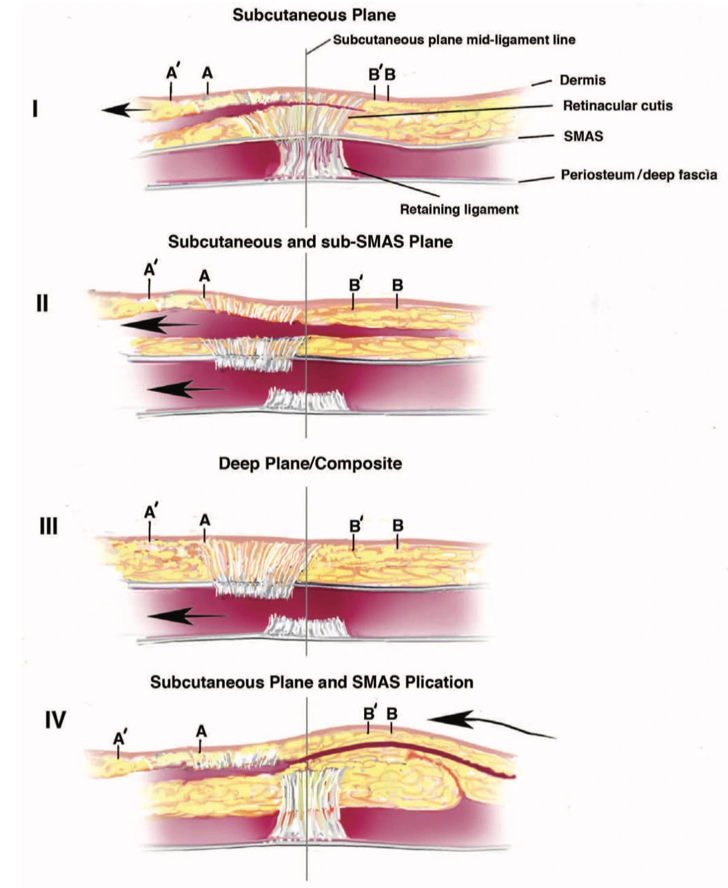 Types of facelift in Korea