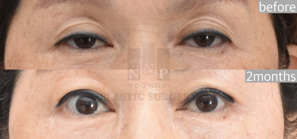 Ptosis Eye Surgery