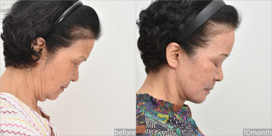 asian facelift results