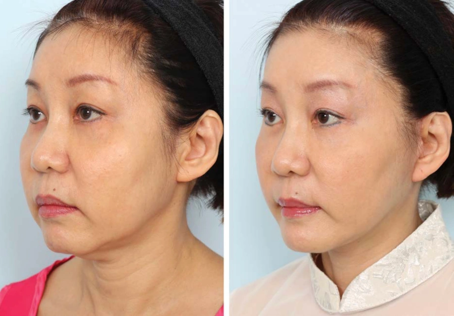 deep plane facelift side effect