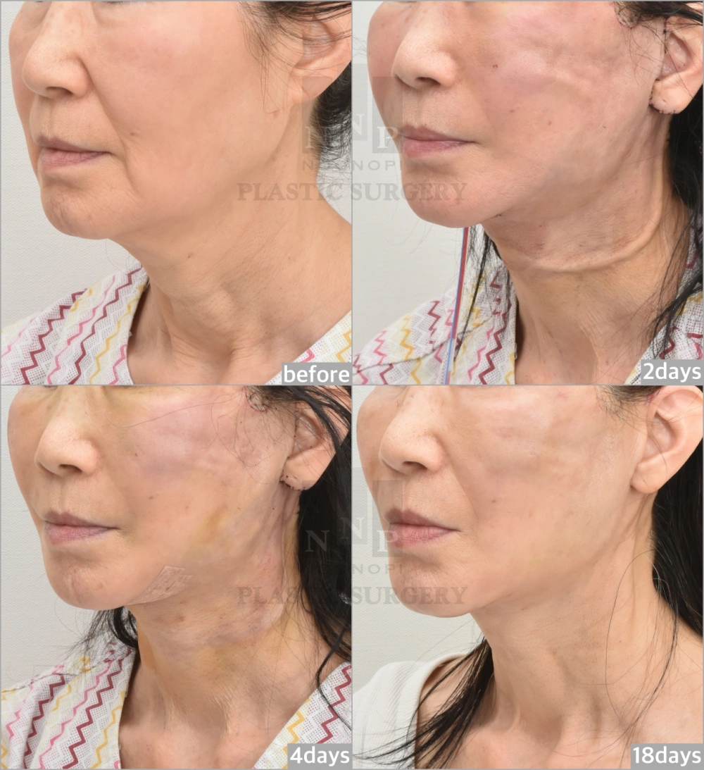 facelift Recovery Day-by-Day