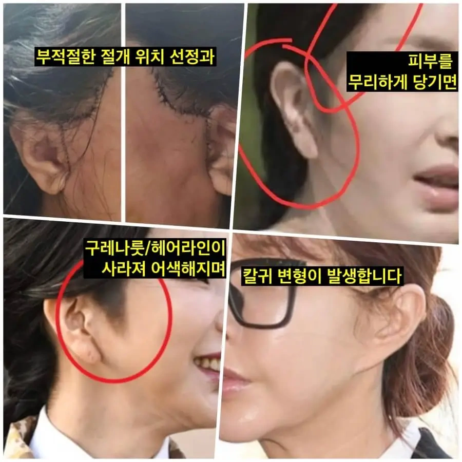 김건희 안면거상술