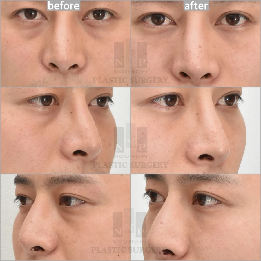 dark circle treatment before after