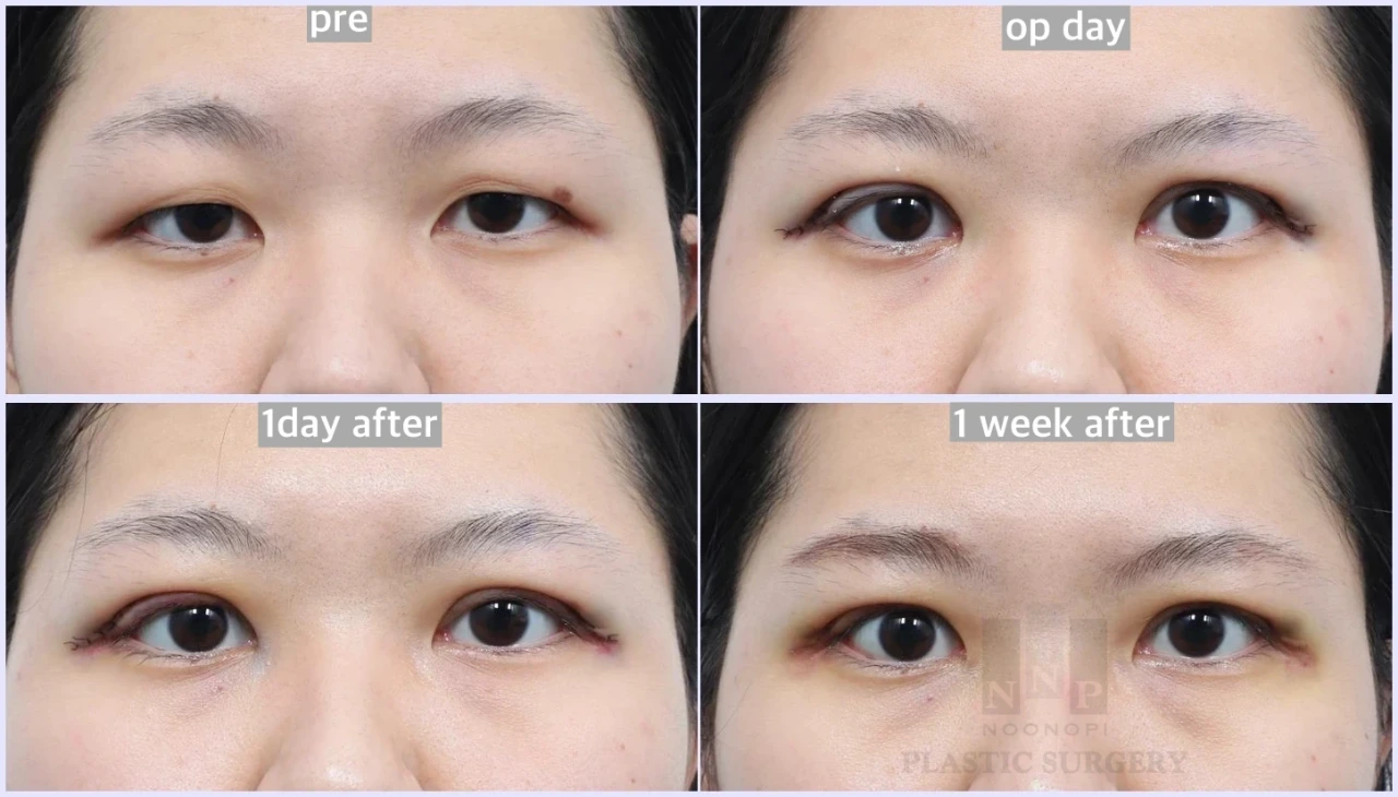 incisional double eyelid before after