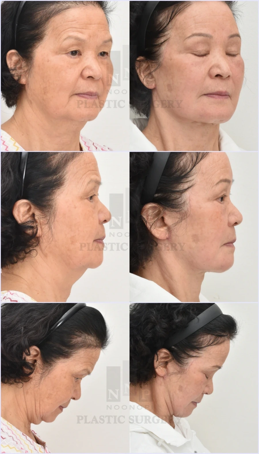 Jowl and neck wattle change after facelift