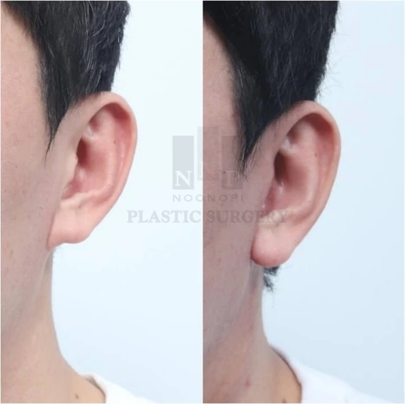 aesthetic earlobe after facelift