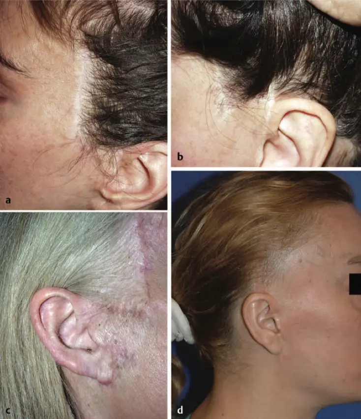 visible scarring and hairline distortion