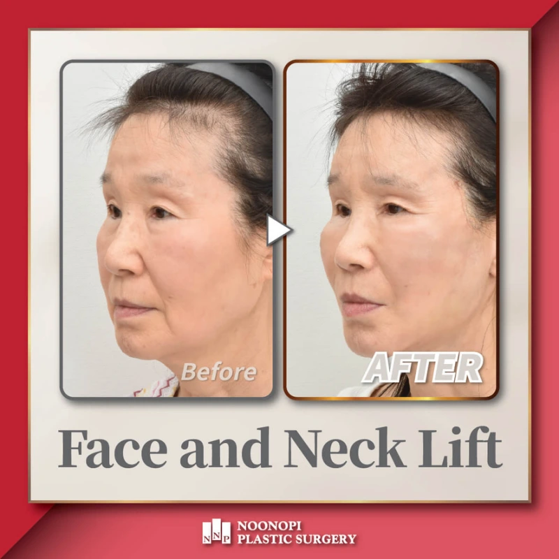 nasolabial fold treatment surgery