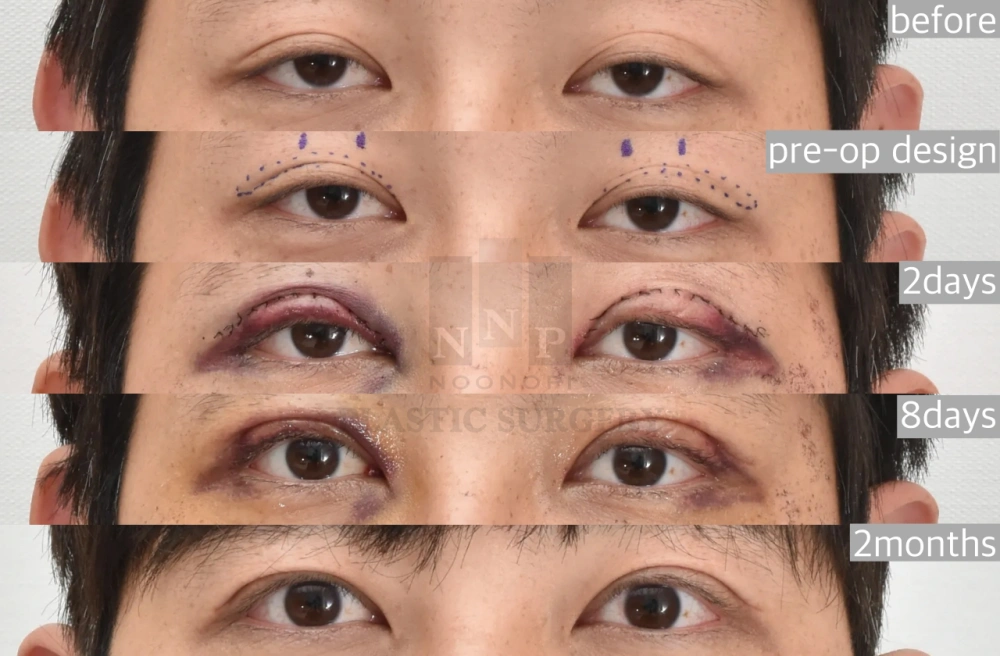 recovery timeline after upper blepharoplasty