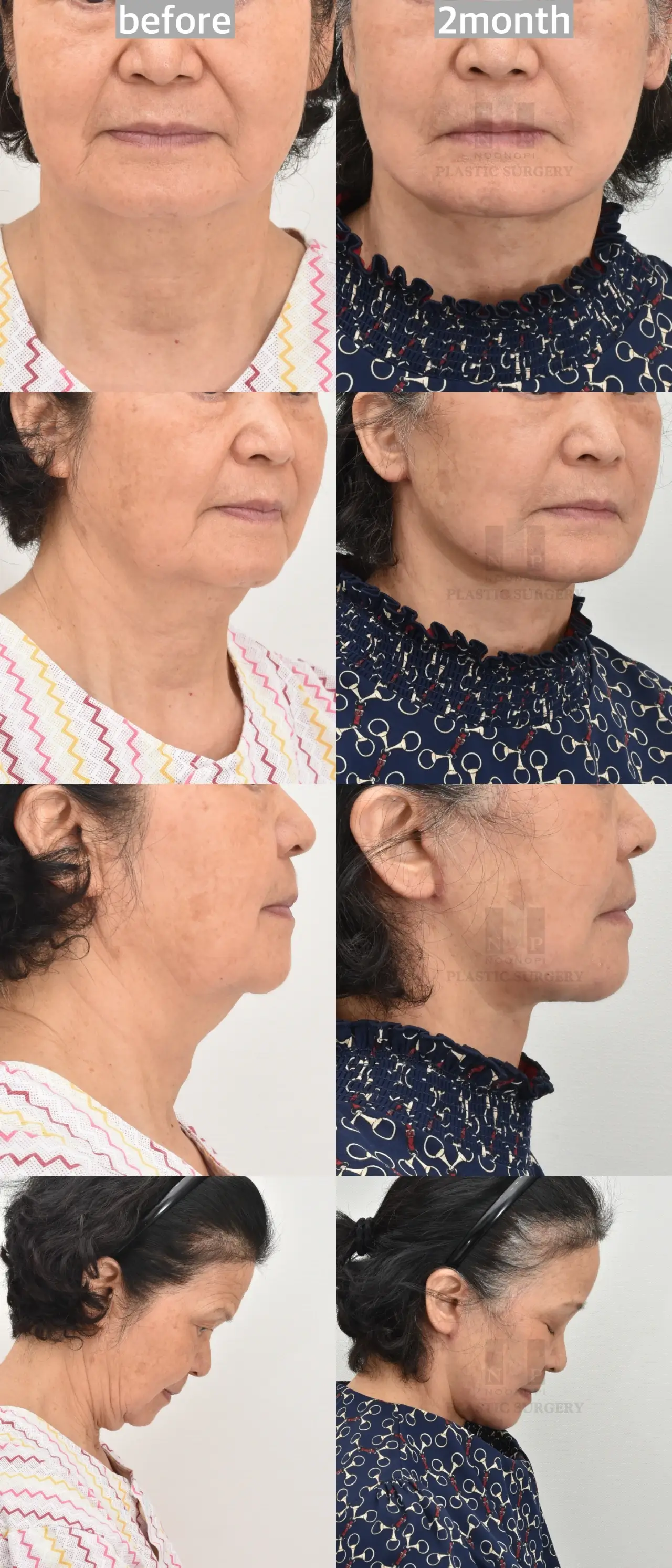 simultaneous facelift and necklift results