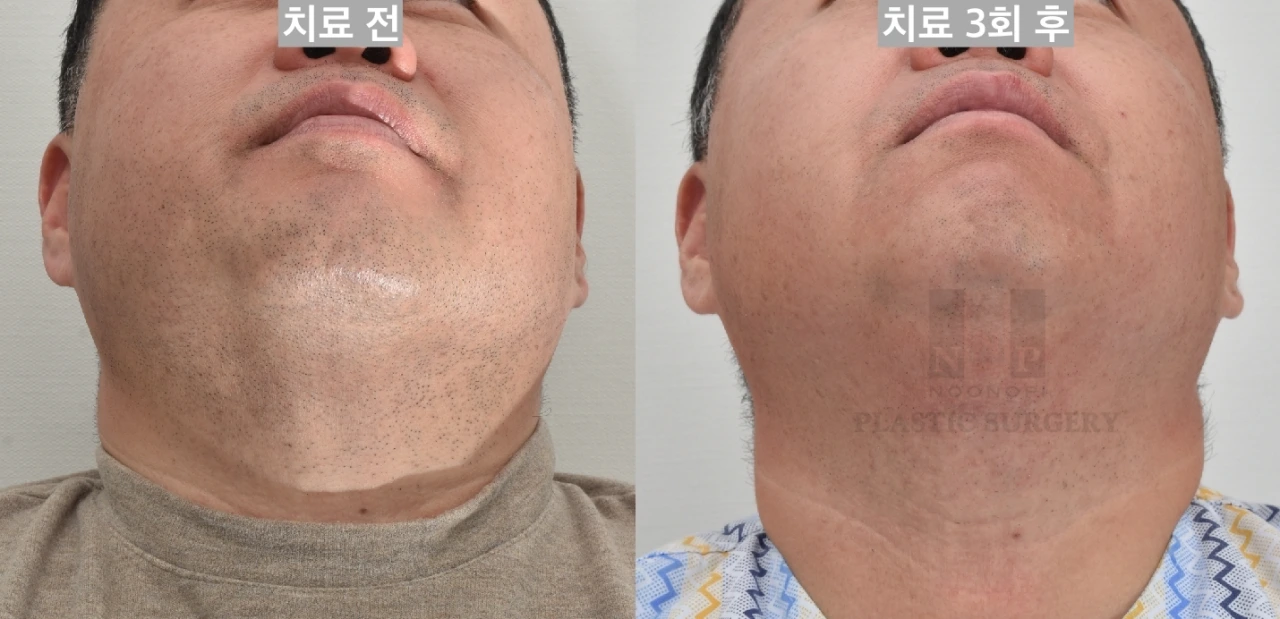 Hair removal results