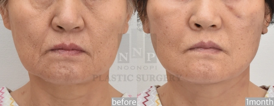 asian facelift cost