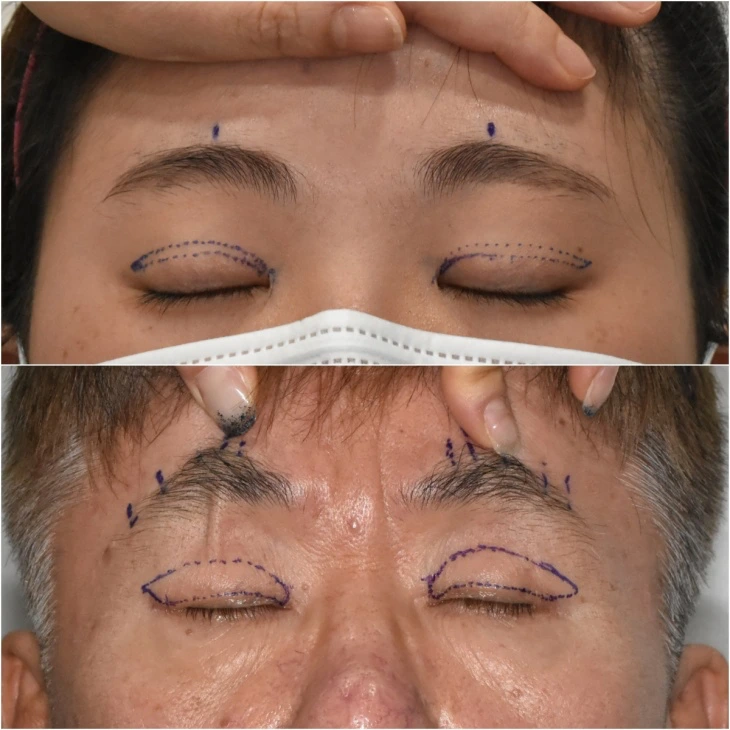 Comparing upper blepharoplasty design