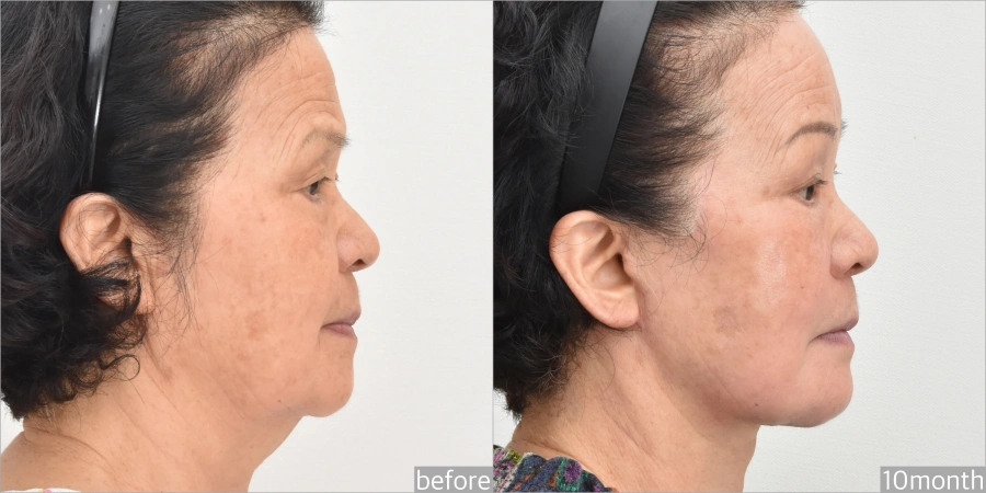 asian face lift before after