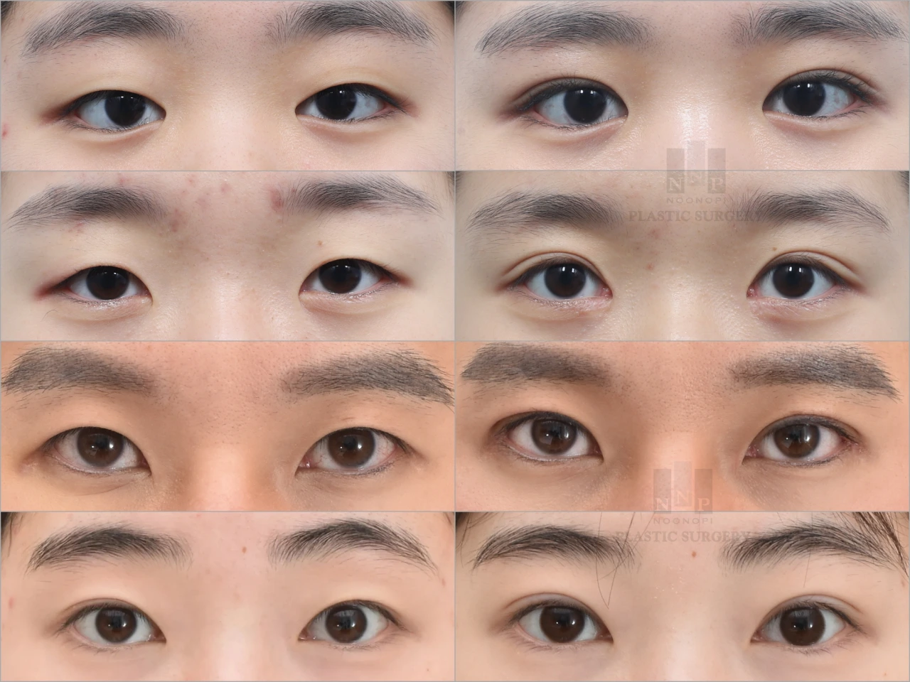 non incisional blepharoplasty before after
